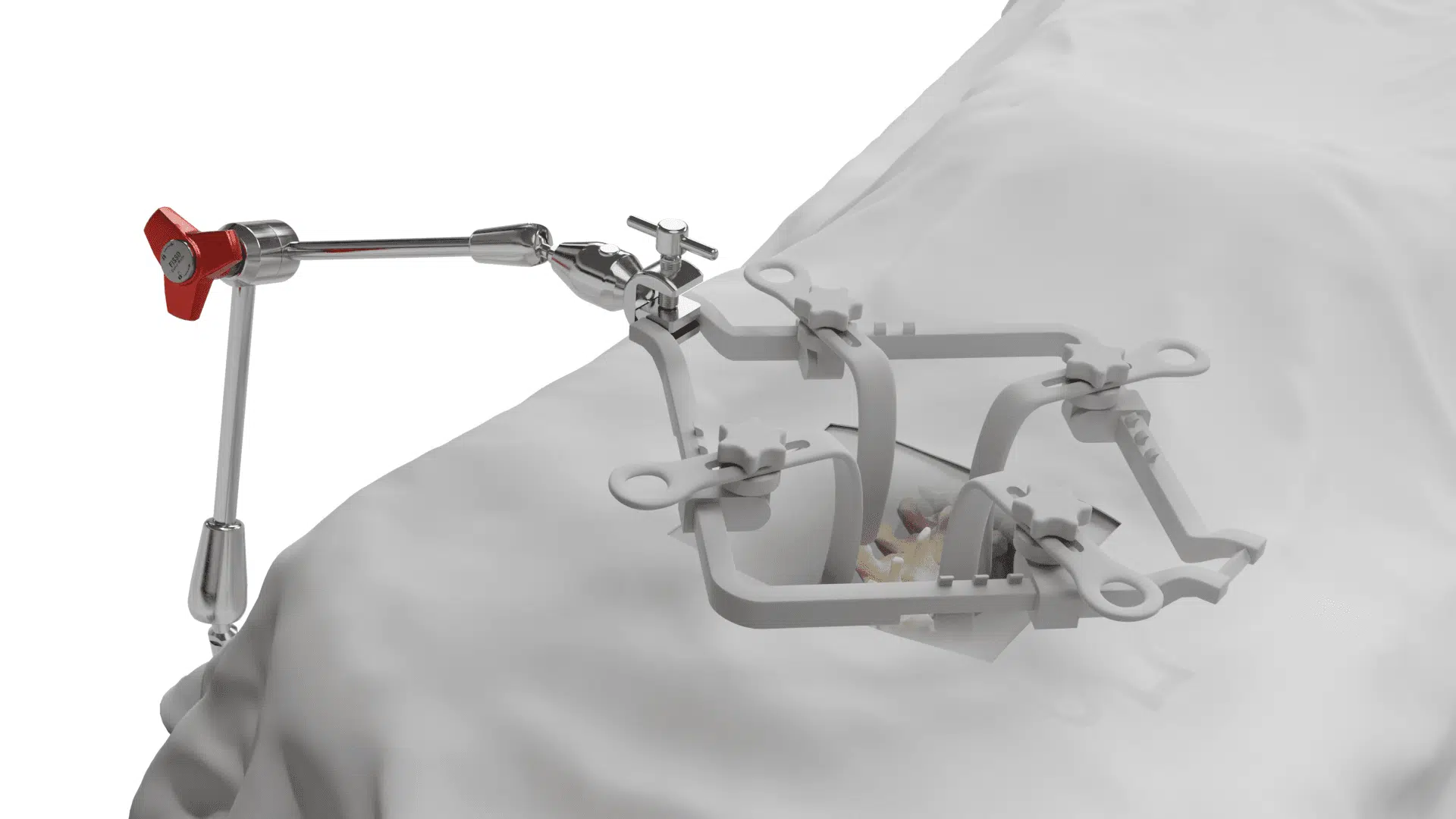 Spine Surgery 11 Ringsystem 1